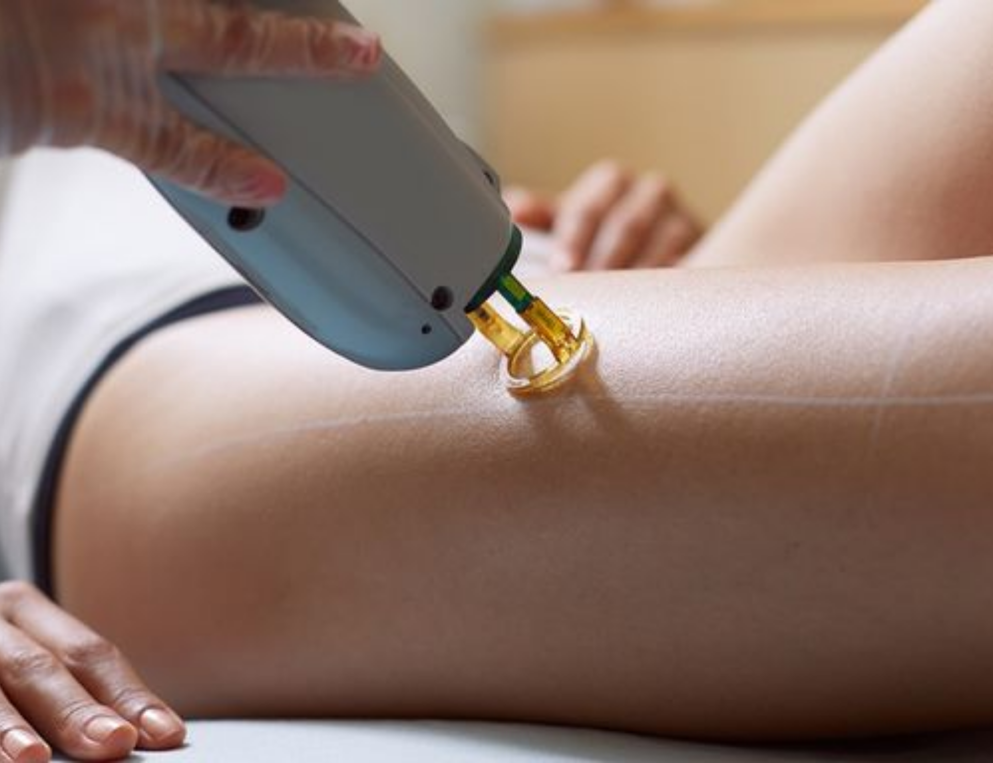 triệt lông bằng công nghệ diode laser