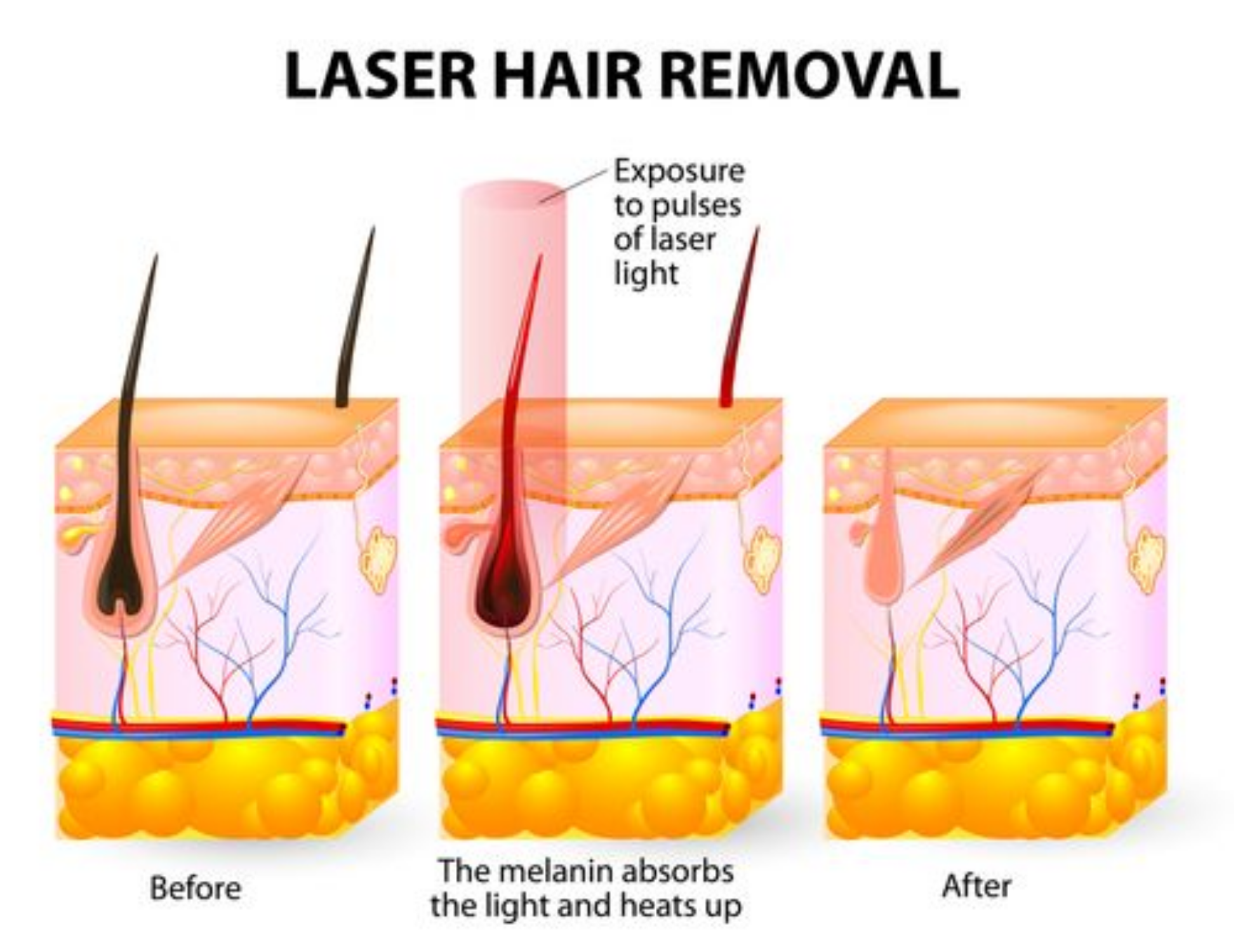 triệt lông bằng laser có vĩnh viễn không